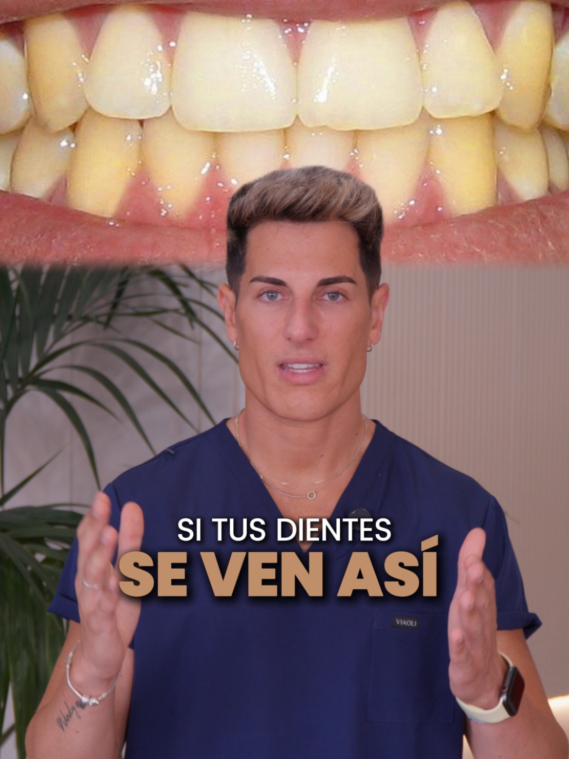 Si tus dientes se ven amarillos aunque te cepilles bien, esto te interesa 👇 Muchas veces no es falta de higiene, sino algo totalmente natural. Debajo del esmalte está la dentina, una capa interna con un tono más amarillento que varía en cada persona. Por eso, aunque tengas una buena rutina de cepillado, el color de tus dientes depende también de tu dentina. 🦷 Si quieres mejorar el tono de tu sonrisa, existen tratamientos profesionales que pueden ayudarte a conseguir un blanco más uniforme y luminoso. #ClinicaDrFranco #EsteticaDental #SonrisaPerfecta #BlanqueamientoDental #EsteticaEspaña