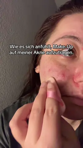 Naja, wenigstens ist mein Concealer aus Südkorea gut. Die Rötungen sieht man kaum, die Hubbel leider schon. 🥲 #akne #acne #acnetreatment #fyp #fy 
