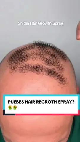 Hair regrowth spray uses PUEBES? 🤮🤮 #comedy #funny #alopecia #puebes 