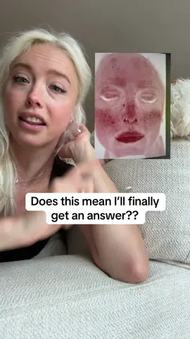 Got to do a skin analysis with @Maeve Aesthetics Clinic at the @ONDA launch party today and the results have me SHOOK!!! Do we think my derm will take this skin analysis into consideration for a firm and final diagnosis of lupus??? Lawrd I hope so.  #skincare #skinanalysis #lupus #dermatology #vasculitis 