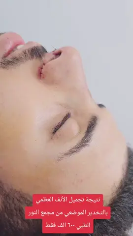 #تجميل_الأنف #دكتورة_نور_امين #مجمع_النور_الطبي #برنامج_الصحة_والجمال 