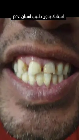 هذا حال اسنان الناس وننصح الف مره وماكو فائدة فلوس ماكو لو ماعندي مجال عندك ماجل لمن كل اسنانك تكوم توجعك وتوصل نقطة الصفر انو تقلعهم ؟؟؟؟ لازم الواحد يروح يجيك اسنانه كل 6 اشهر حتى لو مابيهم شي او ماكو المماكو شي يعوض السن ابداً متوفر علاج مجاني حشوات ضوئية تنظيف الاسنان من التكلسات والتصبغات قلع الجذور والاسنان التالفه تعويض الاسنان المفقودة بطقم متحرك علاج اسنان الاطفال علاج امراض الفم مثل قرحة او تورم وغيرها 07733461779 واتساب 