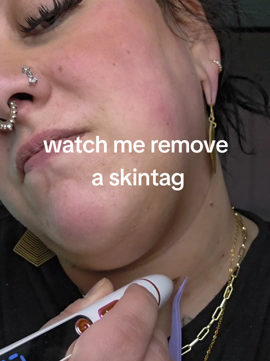 two skintags down! 3 more to goooo!!!! let me know what skin issues you want to see removed #skintag #skintagremoval #matureskincare #tiktokshopfalldealsforyou #skincaredevice 