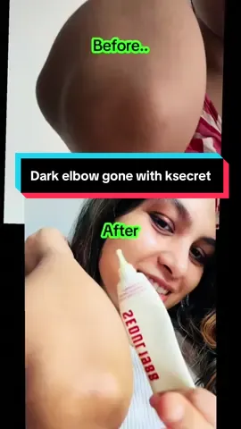 7-day elbow transformation with SEOUL 1988 Eye Cream : Retinal Liposome 4% + Fermented Bean @KSECRET GLOBAL @ksecret_influencer #KSECRETGlowChallenge #KSECRET #Seoul1988 #Retinal #transformationchallenge 