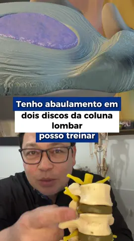 A osteopatia é crucial antes da atividade física para tratar o abaulamento discal lombar ao corrigir a causa raiz do problema, melhorar a mobilidade, aliviar a dor e prevenir lesões. Ao identificar e reequilibrar as disfunções musculoesqueléticas que sobrecarregam a coluna lombar, a osteopatia prepara o corpo para os exercícios, otimizando a performance e evitando que o abaulamento se agrave.  Importância da osteopatia antes da atividade física Aborda a causa raiz: A osteopatia não trata apenas o sintoma (dor), mas busca as disfunções em outras partes do corpo que podem estar sobrecarregando a coluna lombar, como desequilíbrios pélvicos ou musculares. Promove o reequilíbrio: O tratamento visa devolver a funcionalidade a estruturas hipomóveis e eliminar forças anômalas que atuam sobre o disco intervertebral, promovendo uma melhor adaptação do corpo. Reduz a dor e a inflamação: Ao aliviar a pressão sobre a região lombar, a osteopatia diminui a dor e a tensão, criando um ambiente mais saudável para iniciar a atividade física. Previne lesões: Ao preparar o corpo e corrigir desequilíbrios, a osteopatia reduz o risco de agravar o problema durante a prática de exercícios, protegendo contra novas lesões. Melhora a performance: Um corpo mais equilibrado e com a musculatura funcional permite uma melhor realização dos movimentos, o que pode levar a uma melhora no desempenho esportivo. Complementa o exercício físico: A osteopatia trabalha em conjunto com exercícios (como o Pilates Clínico), onde a técnica manual prepara o corpo e os exercícios mantêm e fortalecem os ganhos obtidos. #herniadedisco #lombalgia #coluna #fisioterapia #atividadefisica 