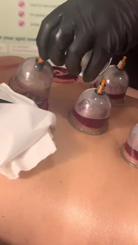 This is what a body reset looks like 😍  #hijama #cupping #wetcupping #CuppingTherapy #HolisticHealing 
