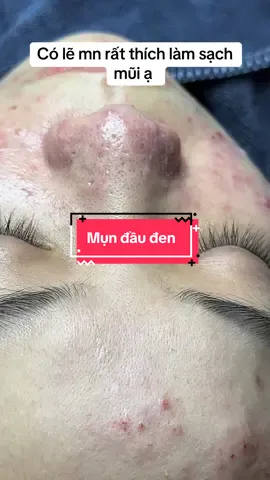 Chiếc mụn đầu đen ở mũi và cách xử lí của spa #nặnmunbangtay #laynhanmunchuanykhoa #Chămdachuẩnykhoa #duocmypham #vairal 