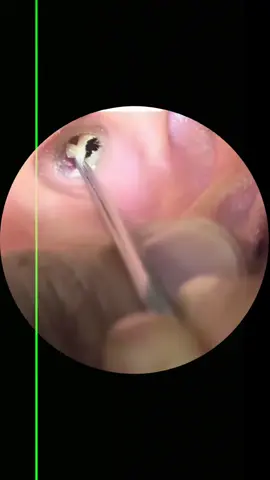 There is a type of person who never gets their ears cleaned but enjoys watching others do it.#tiktokawardsusa2025 #earcleaningasmr #earwax #satisfyingasmrtingsounds #satisfyingasmr 