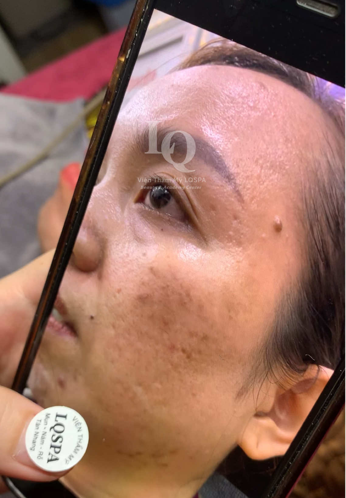 Cập nhật da sạm #chamsocdamun#chamsocdaseo#chamsocdanam#tanbinh#Lqspa&academy