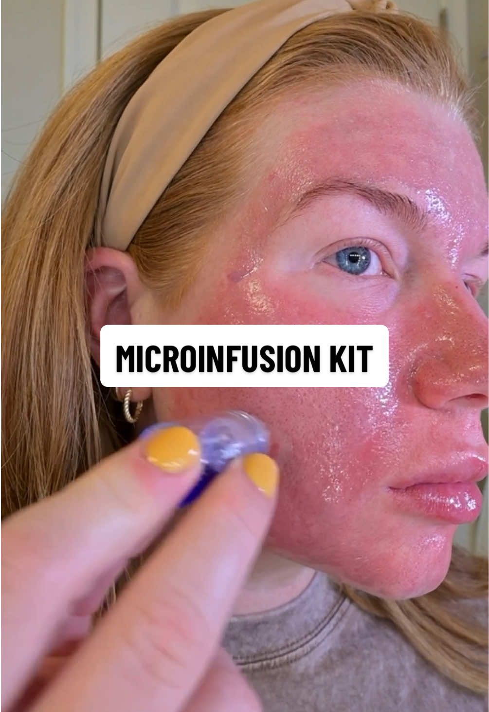 Skip the medspa appointment 👏💉 The Qure 3-Month Wrinkle Micro-Infusion Kit gives you professional-level results at home—targeting fine lines, texture, and elasticity with gold-plated microneedles that deliver active serums deep into your skin. You get 3 months of treatments and that post-facial glow every time ✨ Linked in the orange cart while it’s on deal! @Qure Skincare  #microinfusion #microneedling #skincare #tiktokshopblackfriday #tiktokshopcreatorpicks 