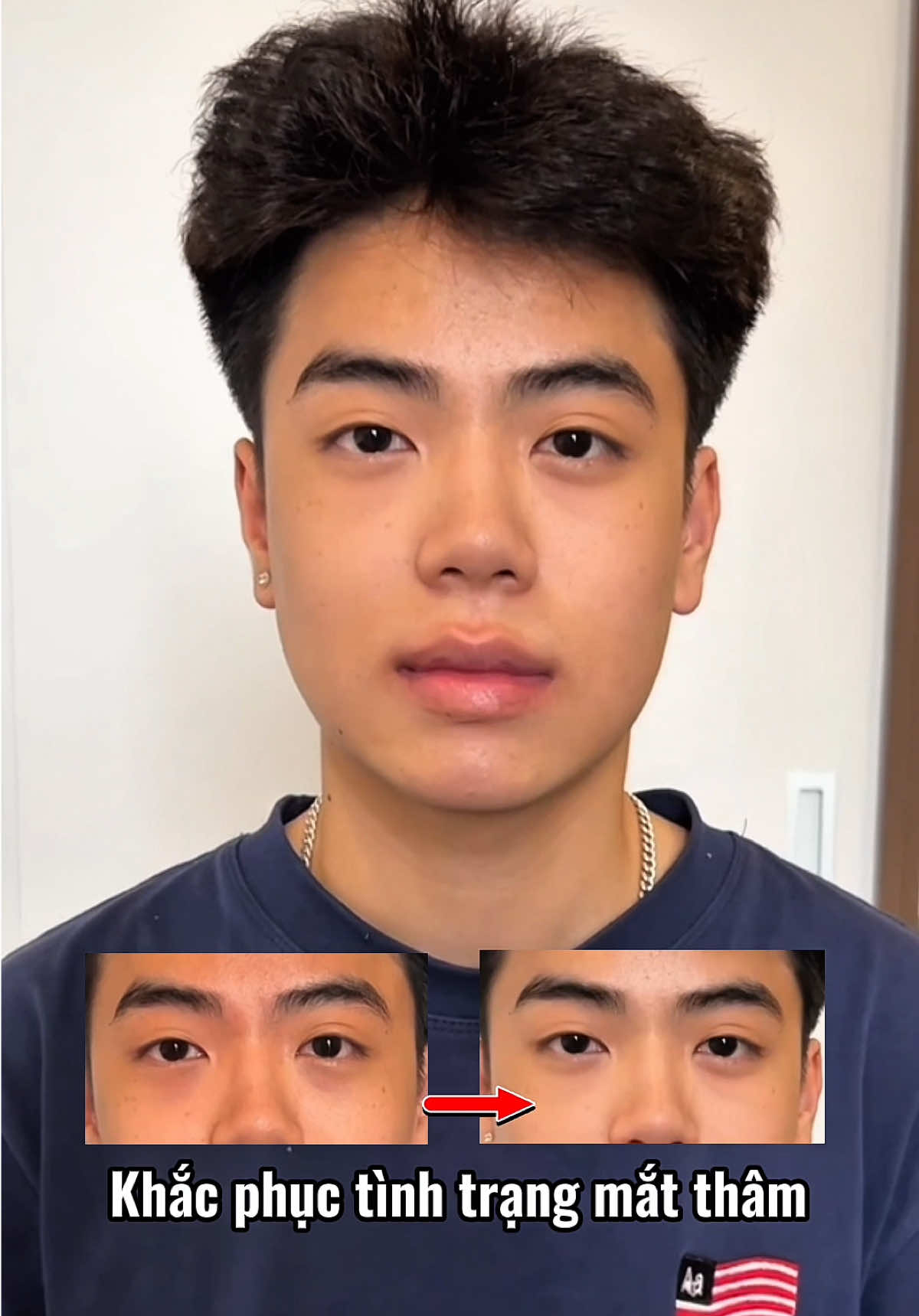 Dấu hiệu của việc tiêu tiền đúng cách #filler #botox #matlech 