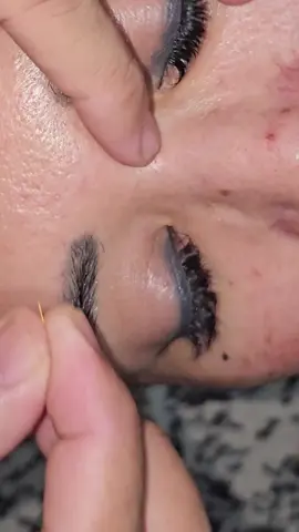 pemasangan susuk emas pasien dr kalimantan.