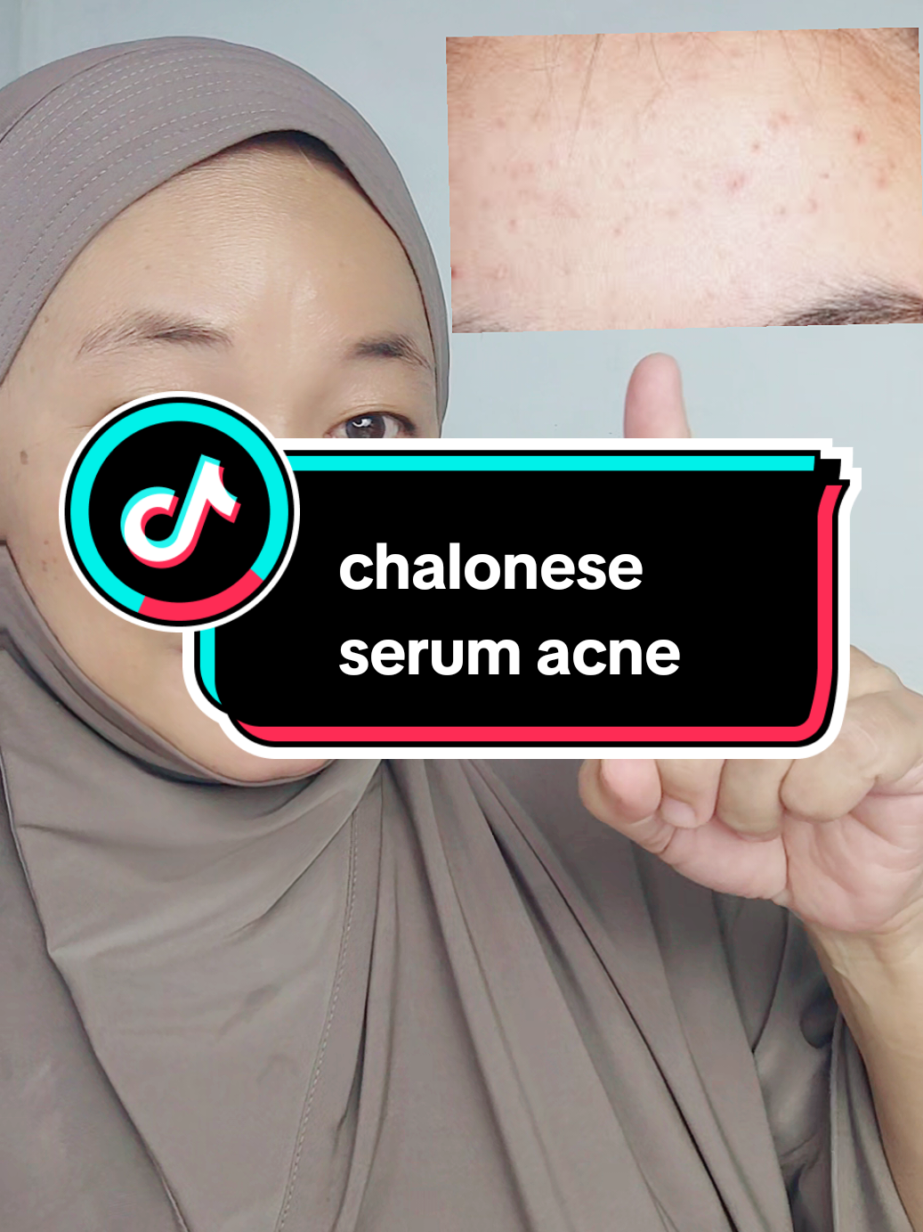 Chalonese  serum jerawat, membantu mengatasi jerawat, membandel sekalipun #chalonese #serumacne  #jerawat #modalkontendoang #sipalingaffiliate 