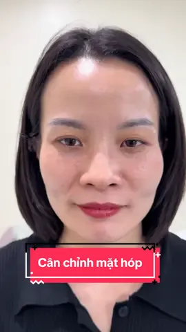 Một ca face siu hóp =)) với những tình trạng hóp nhiều ntn thì nên cân chỉnh filler mới cải thiện được vấn đề, làm khuôn mặt trẻ trung hơn #filler #fillerbotox #lamdep #tiemfiiler #tiemcam 