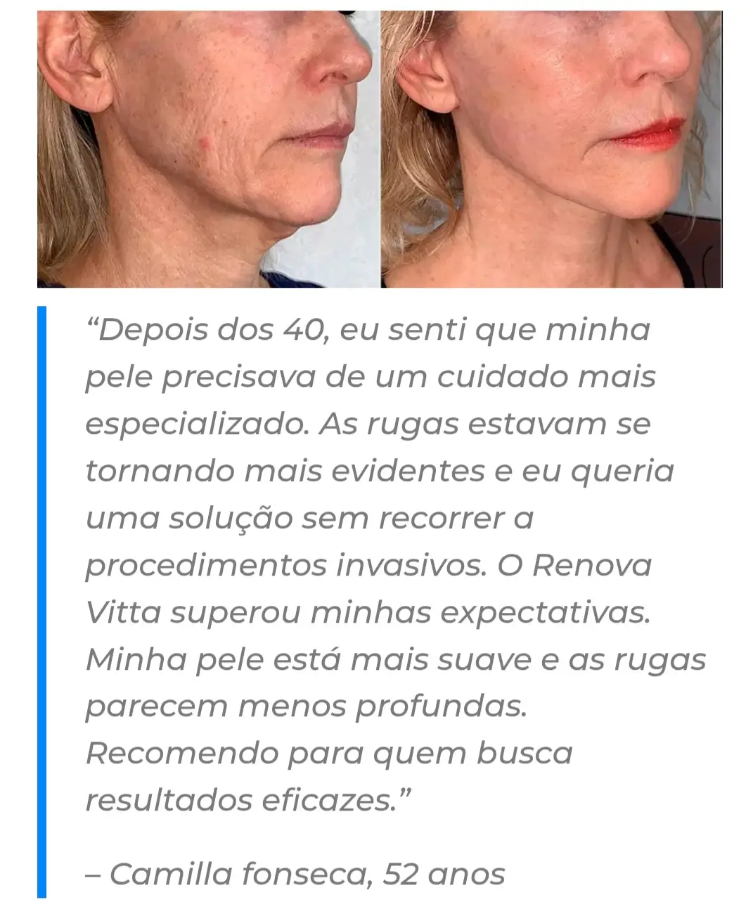 Nem filtro, nem mil cremes… Só o poder do Renova Vitta agindo de dentro pra fora 😍✨ #rejuvenecimientofacial #semflacidez #autoestima #pelesaudavel 