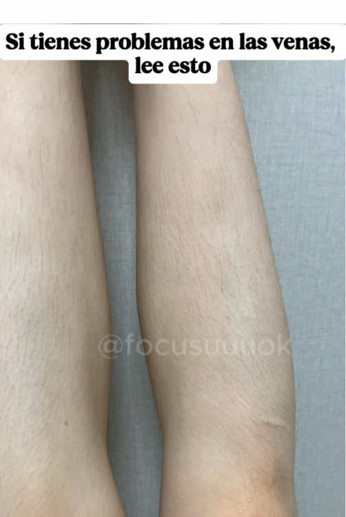 Al tercer día vi que las venas se estaban desvaneciendo 😳#varicosetreatment #dermatology #dermatologist #skincaretips #dermtok #varicoseveins
