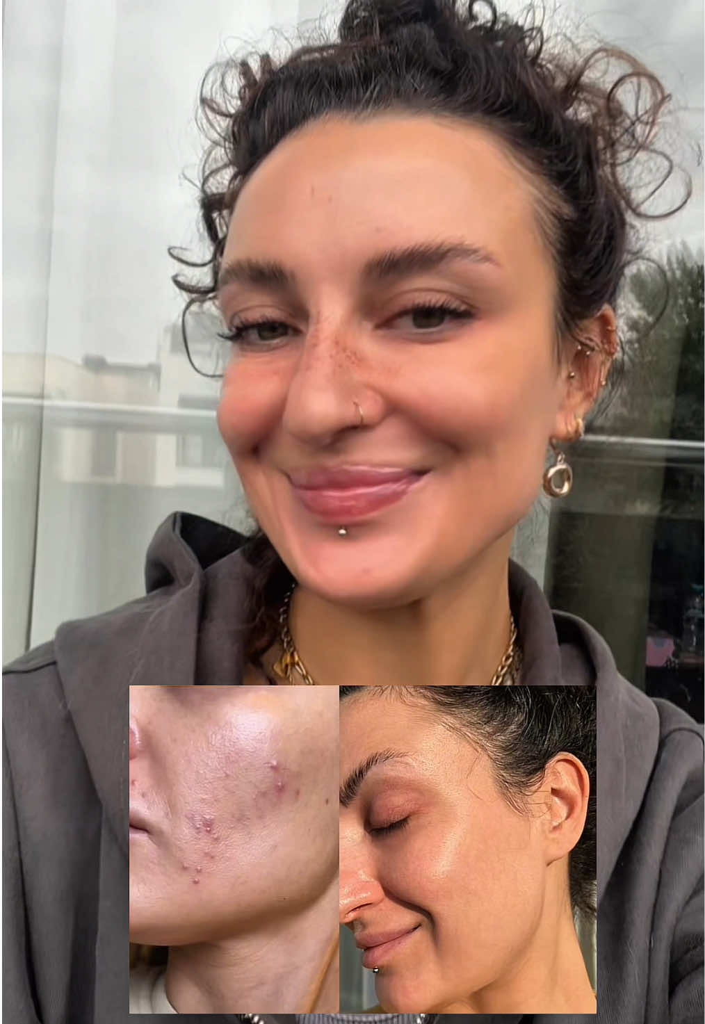 ჩემი აზრით აკნეს დამარცხება უდიდესი წარმატებაა 💅