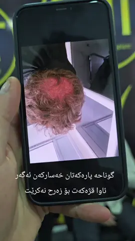 #sarkawt_hair_transplant #kurdistan #foryoupage #foryou #sarkawt_beauty_center 