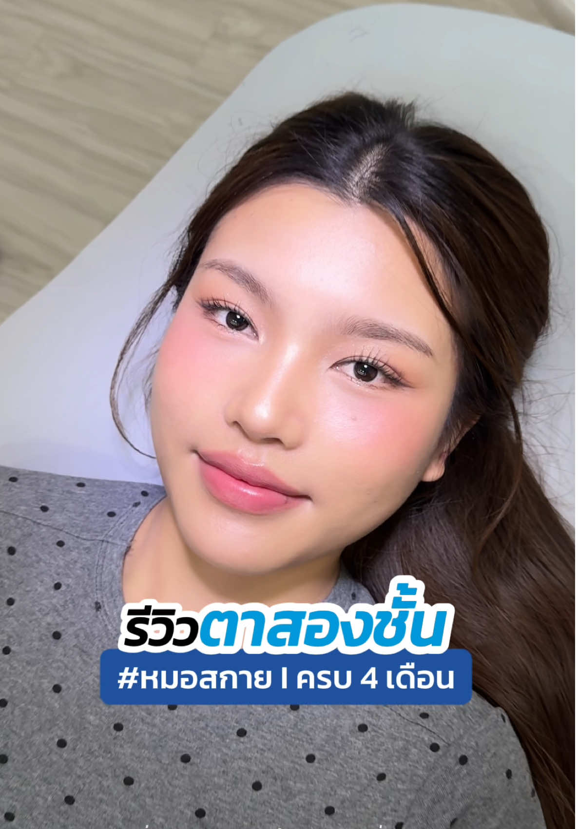 #รีวิวตาสองชั้น 👁️ ครบ 4 เดือน สวยละมุนไม่ไหว 💖 #หมอสกาย  #skyclinic #จักษุแพทย์ #สกายคลินิก 