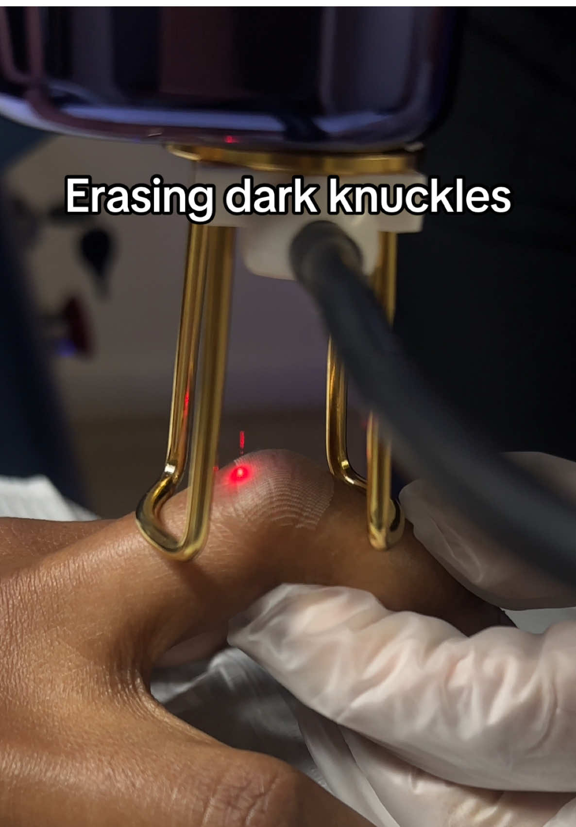 Addressing Hyperpigmentation: A Professional Approach to Treating Dark Knuckles For many individuals, darkening of the knuckles, elbows, and knees is a common concern influenced by genetics, friction, and skin physiology. At @Mysa Medical & Wellness Spa we utilize our advanced, medical-grade CO2 laser technology to effectively target and reduce this hyperpigmentation, promoting a more even skin tone. Packages start at $1500. We are pleased to offer financing options through Cherry, making this treatment accessible. (0% APR available for those who qualify). The patient in this video is currently on her first treatment of a prescribed series of five, which is typically recommended for optimal, lasting results. Our fractional CO2 laser is a versatile tool for skin resurfacing and is not limited to treating knuckles. It is clinically effective for addressing textural and pigmentation concerns on various areas, including: · Elbows · Knees · Toes · Surgical Scars · Stretch Marks · C-Section Scars   …among other concerns. A personalized consultation is essential to determine if you are a suitable candidate and to create a tailored treatment plan. We are committed to transparency; our consultation fee is applied toward any service, and all pricing is clearly listed on our website. Ready to learn more? Schedule your consultation with me today via the link in our bio To support your journey, we provide financing options through Cherry🍒. A Note on Safety and Efficacy: It is our priority to use the safest, most advanced technology. All laser devices at Mysa Medical & Wellness Spa are FDA-approved and have been proven to be safe and effective for treating melanated skin types under professional guidance.