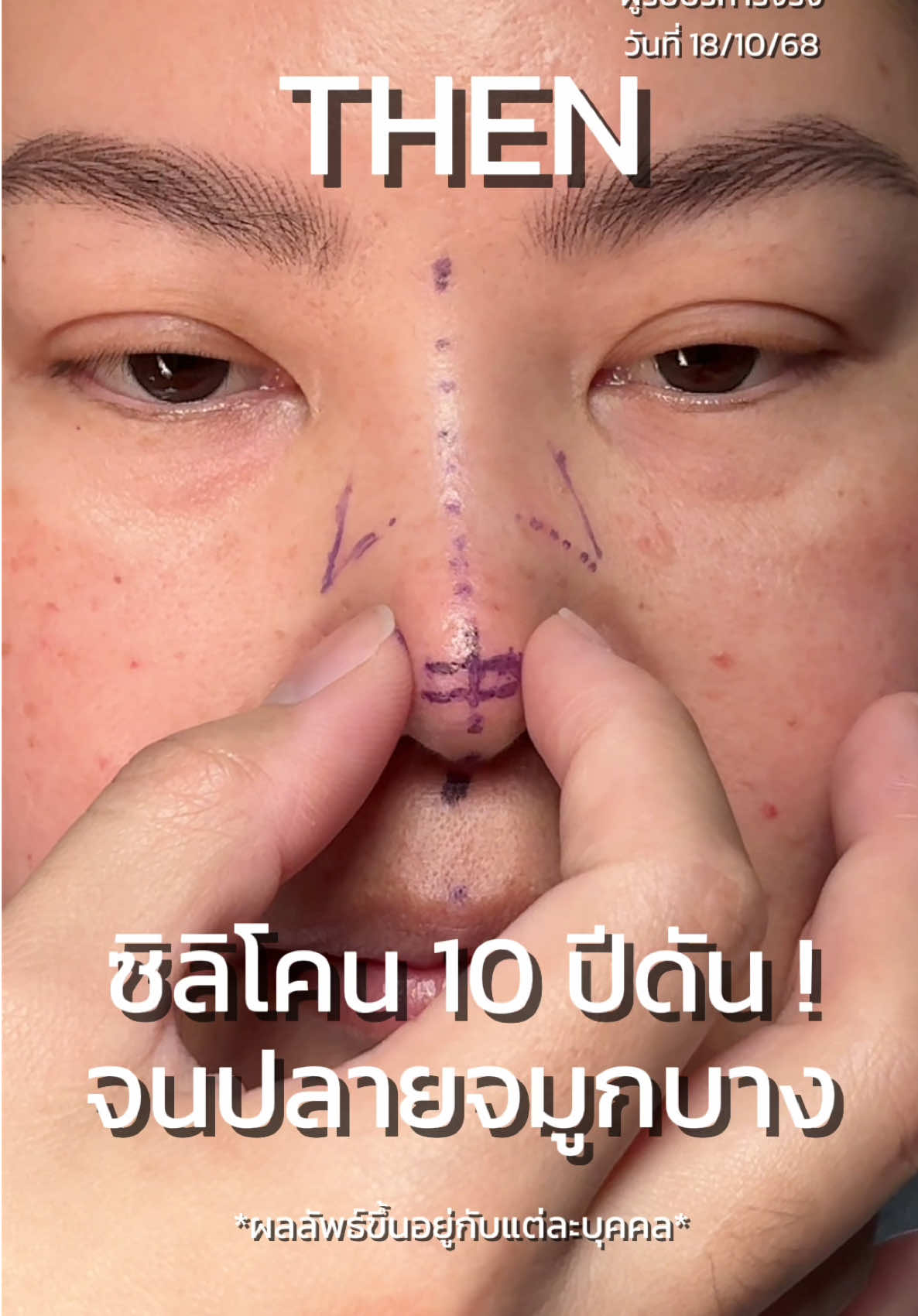 แก้ไขจมูกซิลิโคนเก่า 10 ปีปรับทรงใหม่ให้ปลายไม่บาง สันมีความสโลป ปลายพุ่งขึ้น มีความเป็นธรรมชาติ ดูละมุนขึ้นด้วยเทคนิค Secret Open ใช้ซี่โครงตัวเองมาทำโครงสร้างปลายใหม่ #หมอกรเมโกะ #หมอกรmeko #drkornmekohospital #Mekohospital #เสริมจมูกโอเพ่นซี่โครง