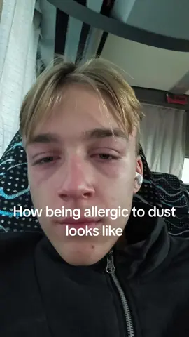 #fyp #allergies 