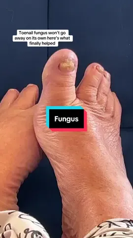 This is what toenail fungus REALLY looks like! Don’t wait! Invest in your feet care today! #fungus #feetcare #antifungal #nailfungus 