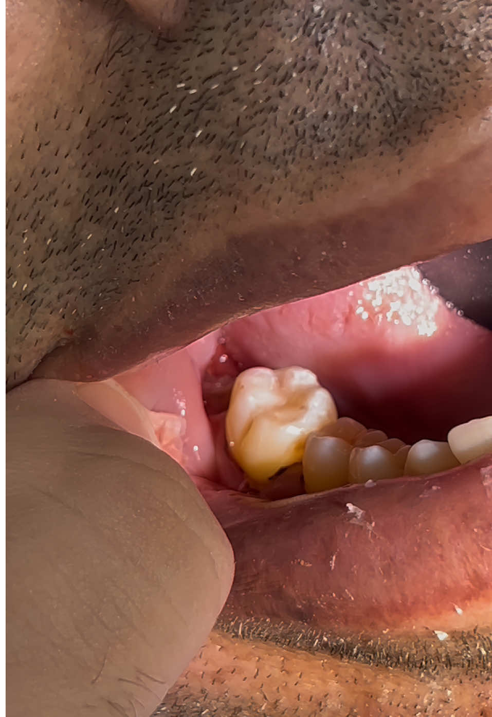 مشاكل ال Deep caries ويا طلاب الرابعة 😂💔 النتيجة تلكوها بغلاف الريلز  . . . . . #CapCut #طب_اسنان #طب #عيادات #تجميل_الاسنان 