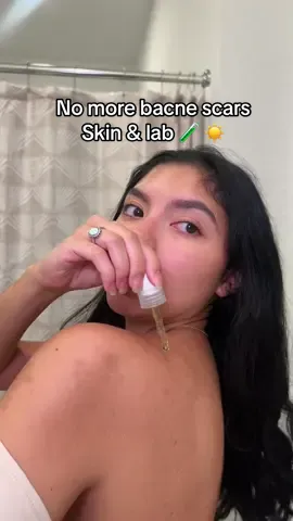 Acne scars? I got you 😌 This vitamin C serum from @Skinlab @skinnlab has been helping even out my skin tone and bring back my glow ✨ 🫶🏼#skinnlab #gentleskincareroutine #skincarehack #skincaretips #glowingskin