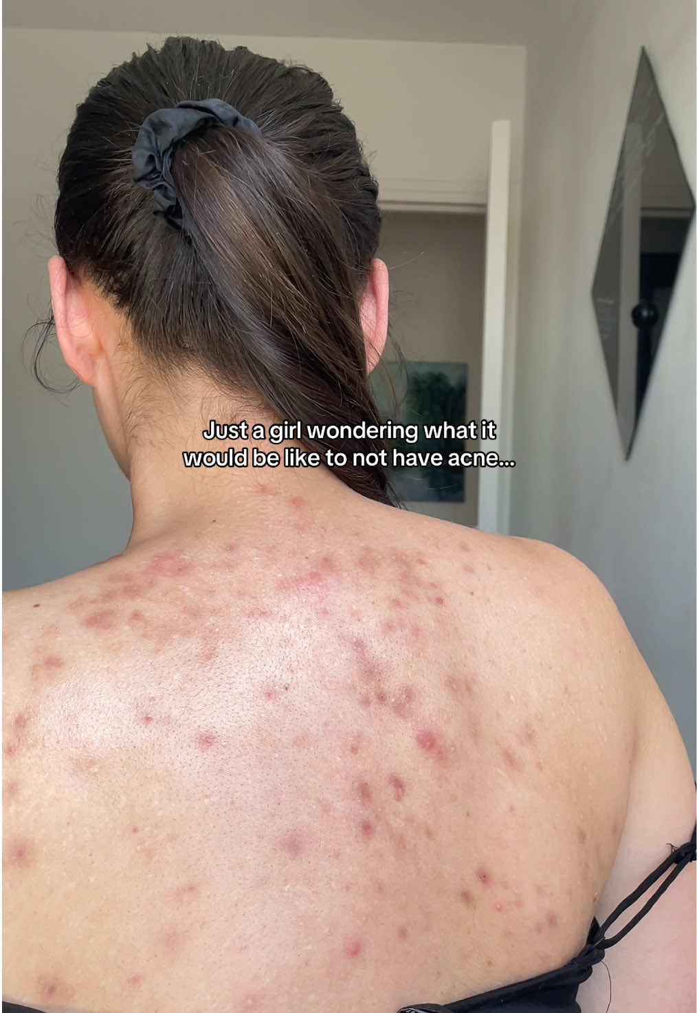 To know this feeling for just a moment… #acne #trend #bodypositive #viral 