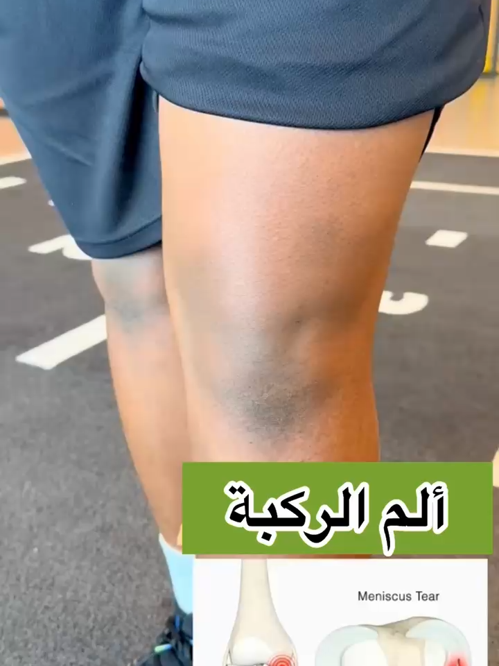 تعاني من ألم عميق داخل الركبة؟ 😣 ممكن تكون المشكلة في الغضروف الداخلي! كثير من الناس يهملون الألم لحد ما يصير احتكاك وتيبّس، لكن الحل الطبيعي موجود 🌿 دهان الحنظل وآلية الشاة يعالج الالتهاب، ينشّط الدورة الدموية، ويخفف الألم تدريجيًا. ابدأ اليوم وارجع تمشي براحة من جديد 💪 الرابط في الأعلى 👆 والتوصيل متاح في جميع مناطق السعودية 🇸🇦 #دهان_الحنظل #آلية_الشاة #الركبة #الم_الركبة #خشونة_الركبة #غضروف_الركبة #المفاصل #التهاب_المفاصل #وجع_العظام #الطب_البديل #علاج_طبيعي #المفاصل_الروماتيزم_الظهر_العظام #مفاصل_وجع_التهاب_عظام_عظم_الم #السعودية #تيك_توك_السعودية #الشعب_الصيني_ماله_حل😂😂