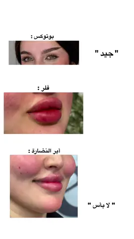 الفلر ملك الساحة 😂❤️ و اكيد كل الي بالصورة شغلي❤️ البوتوكس لرفعة الحاجب و الشفه و البنية الاخيرة مسويتلها نضارة و تغيير شامل