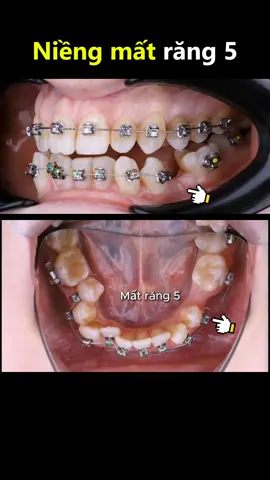 Niềng răng khi mất răng số 5 #niengrang #niengrangmaccai #orthodontist #braces 