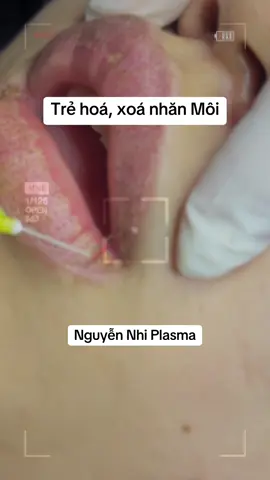 Plasma trẻ hoá môi! #plasma #dayplasmahochiminh #plasmafibroblast #plasmamoi #PLASMA 