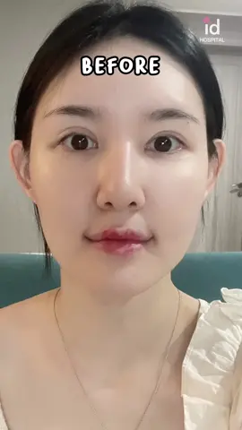 K-Idol Visuals: Now Your Reality! ✨ From ordinary to a true K-Idol face! At id Hospital, we’ve helped achieve the perfect V-line balance and golden ratio symmetry through meticulous jaw reduction, delicate cheekbone contouring, and customized rhinoplasty. The signature look of K-beauty icons is now reborn right here, on your face. ✈️ A special destination for K-beauty dreamers worldwide! Welcoming patients from Singapore, Los Angeles, Sydney, Bangkok, Dubai, and all corners of the globe. Experience the artistry of medical technology at id Hospital, Seoul. This is where science meets beauty, and true confidence begins. 💬 DM us now to start your personalized consultation! Embark on your beautiful transformation journey with id Hospital. #KBeauty #KoreanPlasticSurgery #JawReduction #CheekboneSurgery #Rhinoplasty                     