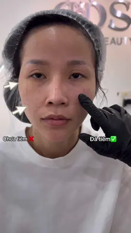 Cân chỉnh face trẻ trung lifting thái dương và tầng mặt giữa ✅ #canchinhkhuonmat 