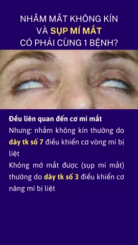 mắt nhắm ko được và mắt mở ko được?