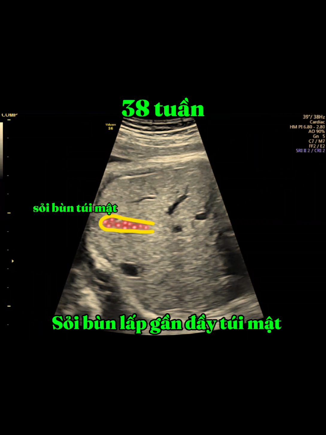 38 tuần Sỏi bùn túi mật #sieuam5d #bshuynam  #sieuambsnam 