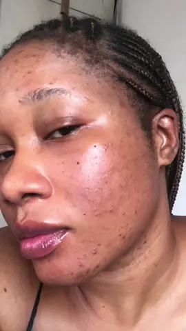 Trust me… I KNOW BALL 🤏🏽✨ #skintransformation #skinjourney #acnetreatment #hyperpigmentation #skincaretips 