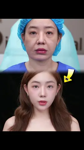 Da nhão, chảy xệ, nhăn nheo, lão hoá không còn là nỗi đáng sợ #viral #fyb #xuhuong #beauty #facelifting 