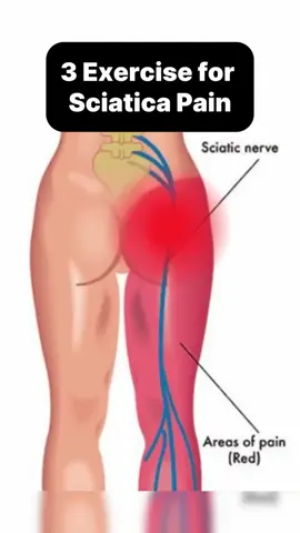 Sciatic pain can range from mild to intense discomfort. These simple exercises help tone muscles and strengthen nerves—even if you don't have pain yet! 💪✨ Follow @backpaintransformation for more! Via vinayyoga #sciaticpain #mobility #posture #stretching #backpain #Fitness #wellness