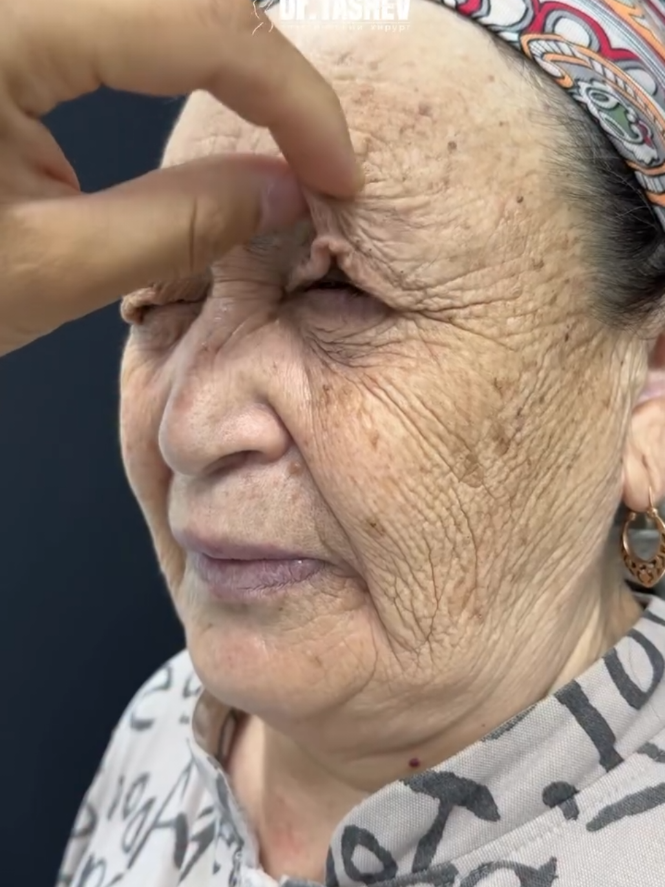 Before and after blepharoplasty  #blepharoplasty #facelift 