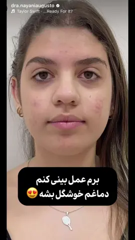 این یه فاجعه است اگر بدونی...🫡 که عمل بینی قشنگ می‌تونه همین بلا رو به سرت بیاره 💔 چند روز پیش یکی مراجعه کرده بود برای مشاوره عکسی که فرستاده بود، در ناحیه میانی بینشی فرورفتگی داشت که از تخریب غضروف بینیش نشئت می‌گرفت  این فرد به خاطر انحراف جزئی که داشت مجبور شده بود حدوداً ۵ سال پیش داخل تهران عمل بینی انجام بده که پس از گذشته حدوداً چند ماه که ورم بینیش از بین میره متوجه این موضوع میشه که غضروف میانی بینیش تا حد زیادی تخریب شده  و خوب پس از کل صحبت به این نتیجه رسیدیم که که اصلاً هیچ کاری دیگه نمی‌شد کرد...🥲 این داستان می‌تونه داستان تو یا هر کس دیگه‌ای که می‌خواد عمل کنه باشه ... اگر توام از بینیت ناراضی و درگیر مشکلات جزئی هستی و نمی‌خوای بری هزینه عمل بدی این عوارض رو بچشی، من اینجام تا کمکت کنم 🫂 اگر می‌خوای که به طور کامل و تخصصی مشاوره بشی این زیر کلمه «مشاوره» رو برام بفرست تا راهنمایت کنم ✨ #عمل_بینی #بینی_گوشتی #عمل #رینوپلاستی #reels 