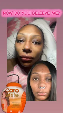 4 months ago I randomly grabbed this cream at the beauty supply store and it completely changed my skin. Yes it is a bleaching cream and no I do not want to look like Michael Jackson. I only wanted to fade my hyperpigmentation and clear the bruising on my face after my nose job and it did exactly that. #carowhite #skincare #clearskin 