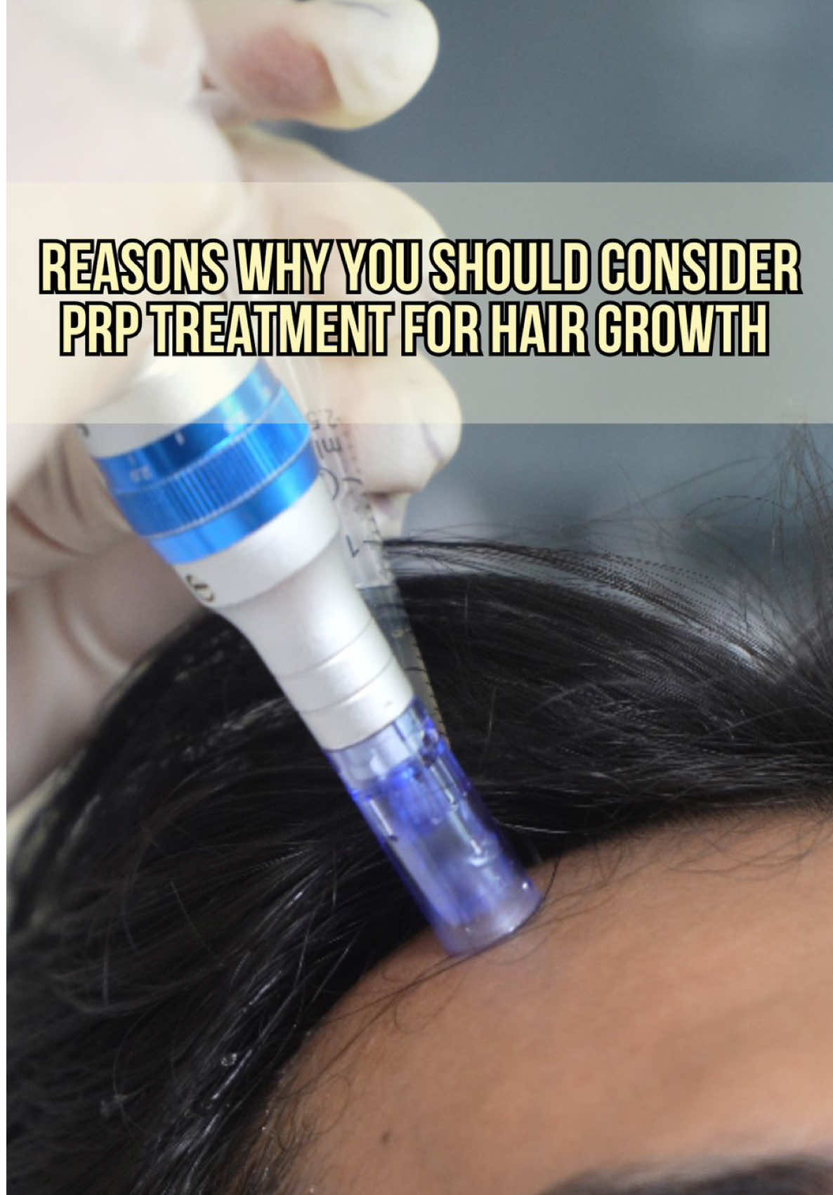 🎥 Watch to find out 5 reasons why 𝐏𝐥𝐚𝐭𝐞𝐥𝐞𝐭-𝐑𝐢𝐜𝐡 𝐏𝐥𝐚𝐬𝐦𝐚 (𝐏𝐑𝐏) 𝐇𝐚𝐢𝐫 𝐓𝐫𝐞𝐚𝐭𝐦𝐞𝐧𝐭 is worth the try for hair growth. This regenerative procedure helps stimulate inactive follicles and improve scalp health using natural growth factors from the body. It’s a safe, non-surgical solution for those experiencing hair thinning or hair loss. Book a consultation to explore 𝐏𝐑𝐏 𝐇𝐚𝐢𝐫 𝐓𝐫𝐞𝐚𝐭𝐦𝐞𝐧𝐭 today. 📍 Visit us at 4/F Estancia Mall, Capitol Commons, Pasig City #PRPHair #HairWellness #AestheticTreatment #HealthyScalp 