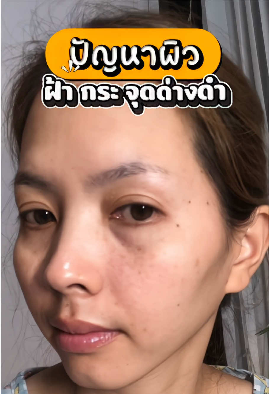 หลังจากใช้มิครายเซรั่มต่อเนื่องทุกวัน เป็นเวลา 14 วัน ไปดูกันได้เลย 🌸 #mekrai #มิครายเคลียร์ฝ้า #มิครายเซรั่ม #ฝ้ากระ #จุดด่างดํา 