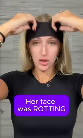 Her skin was losing a war with bacteria. 🧫 OG’s Acne Glow Up Kit turned the tide. 🌿💧 #ogskincare #skinhealth #skincare