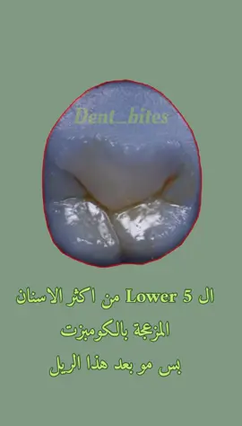 #حشوات_الكومبوزت #dental #explore #fyp #طالب_طب_اسنان 