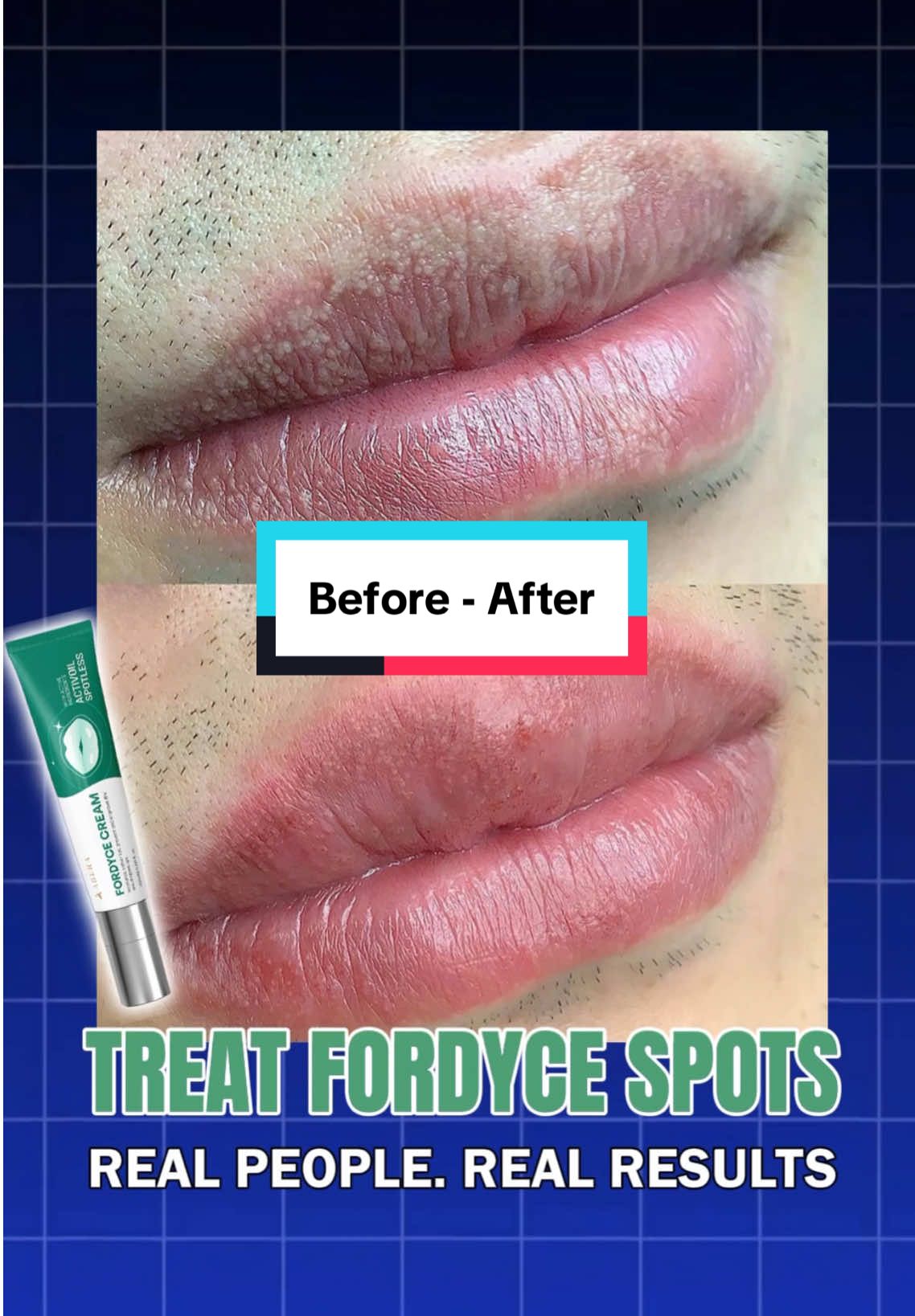 Treat Fordyce spots on your lips — real before & after results in just 4 weeks. Trusted by hundreds of customers #aberafordyce #fordyce #fordycespots #fordycespotsonlips #manchasdefordyce 
