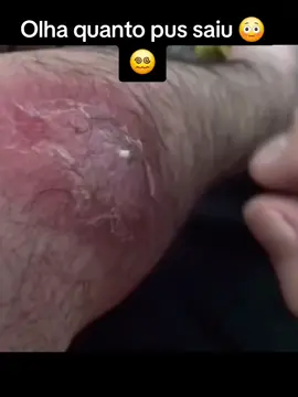 Nascida enorme #cravosgigantes #foryoupage #cravoseespinhas #videossatisfatorios #react 